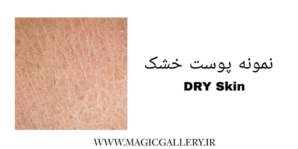شناخت نوع پوست و اهمیت آن در مراقبتهای پوستی (راهنمای جامع + تحلیل علمی) 4 IMG 20250710 192207 567