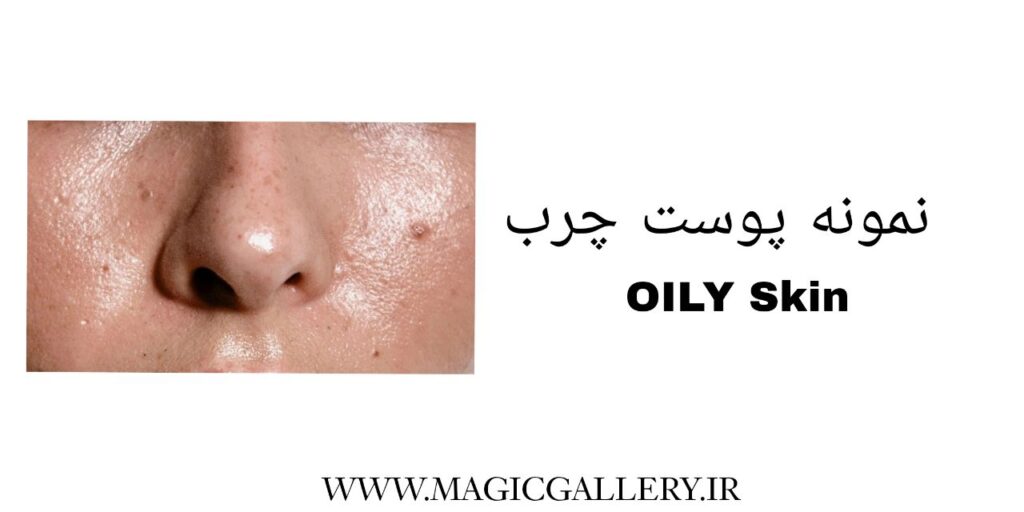 شناخت نوع پوست و اهمیت آن در مراقبتهای پوستی (راهنمای جامع + تحلیل علمی) 3 www.magicgallery.ir-oilyskin