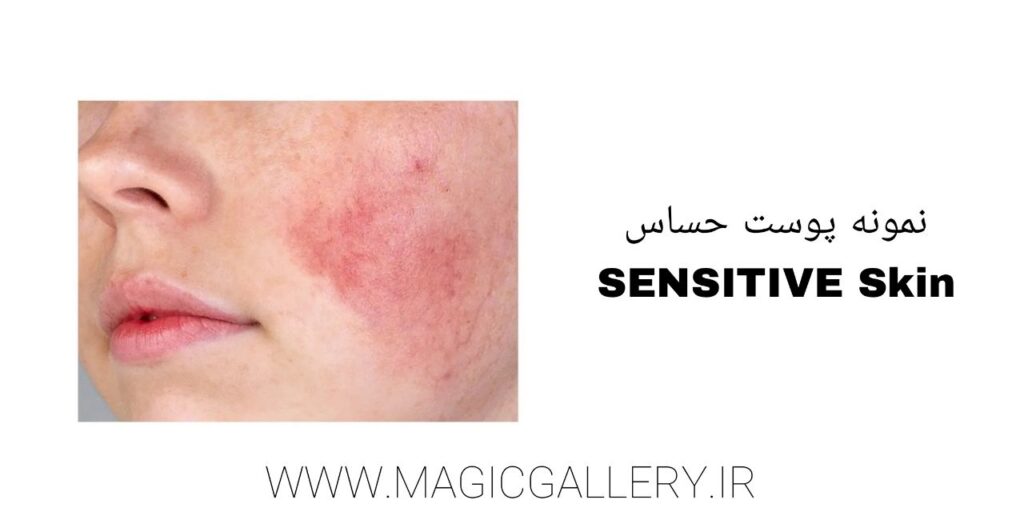 شناخت نوع پوست و اهمیت آن در مراقبتهای پوستی (راهنمای جامع + تحلیل علمی) 6 نمونه پوست حساس